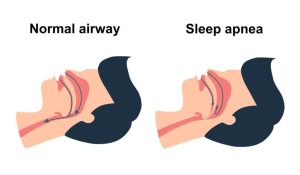 signs you have sleep apnea and not insomnia